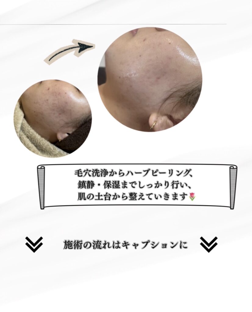 名護市Classy＆TrueMeのハーブピーリング施術写真。毛穴洗浄ハイドラフェイシャルから鎮静保湿まで土台を整える工程。