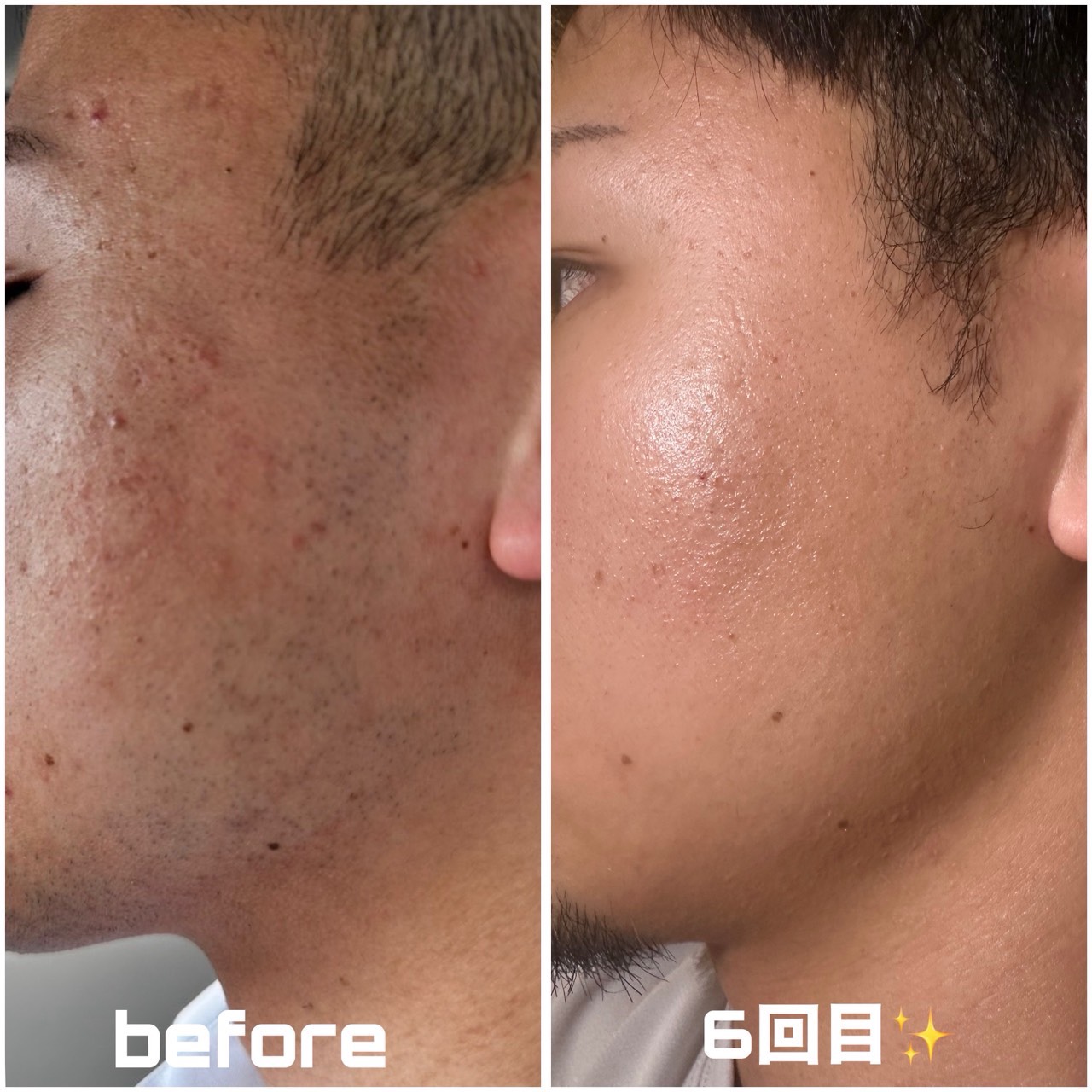 名護市Classy＆TrueMeの男性ヒゲ脱毛実績。カミソリ負けによる肌荒れ（before）が解消され、施術後（after）は健康的な肌質へ。