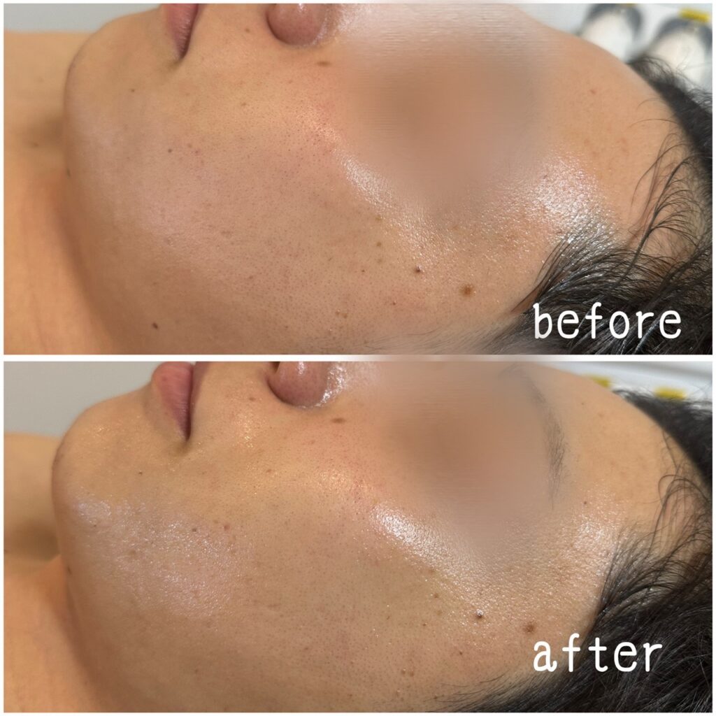 印象管理専門店Classy&TrueMeエステサロンで数回通われている男性の写真。
数回も通われているのできれいな肌になっている。
※効果には個人差があります。