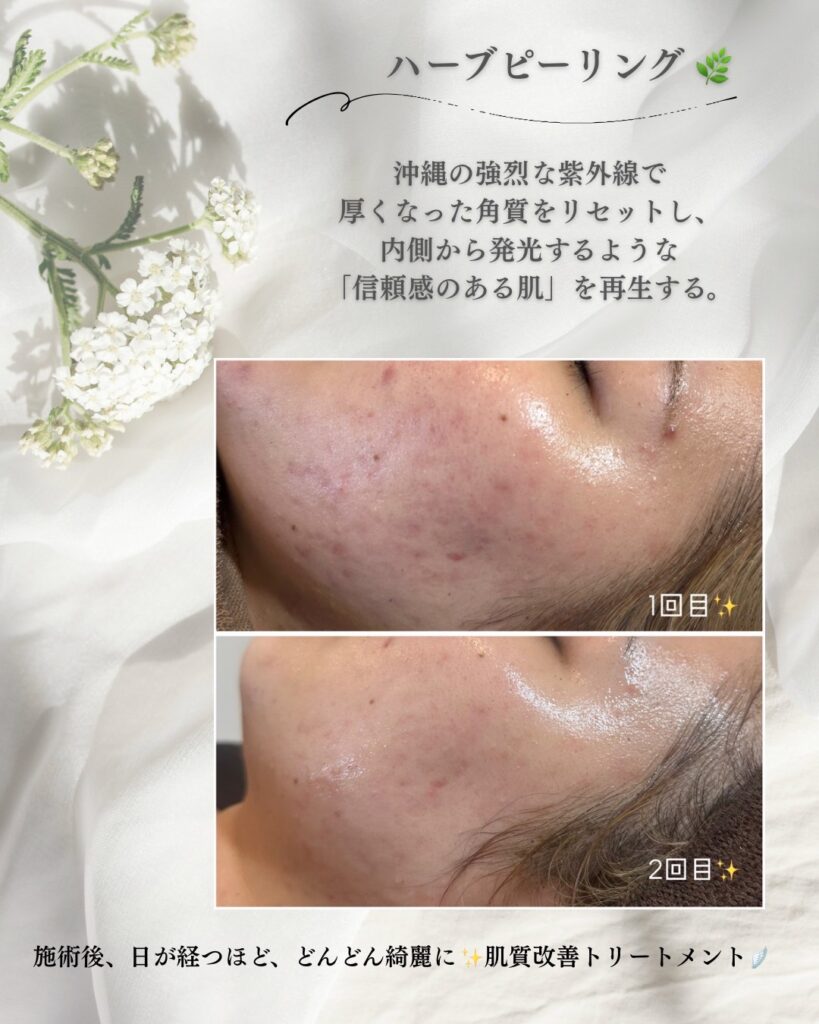 Classy&TrueMe印書管理専門店でハーブピーリングを2回したお客様のお肌、2回で赤身やニキビがほとんど目立たなくなり内側から発行するような肌になってる写真があります。