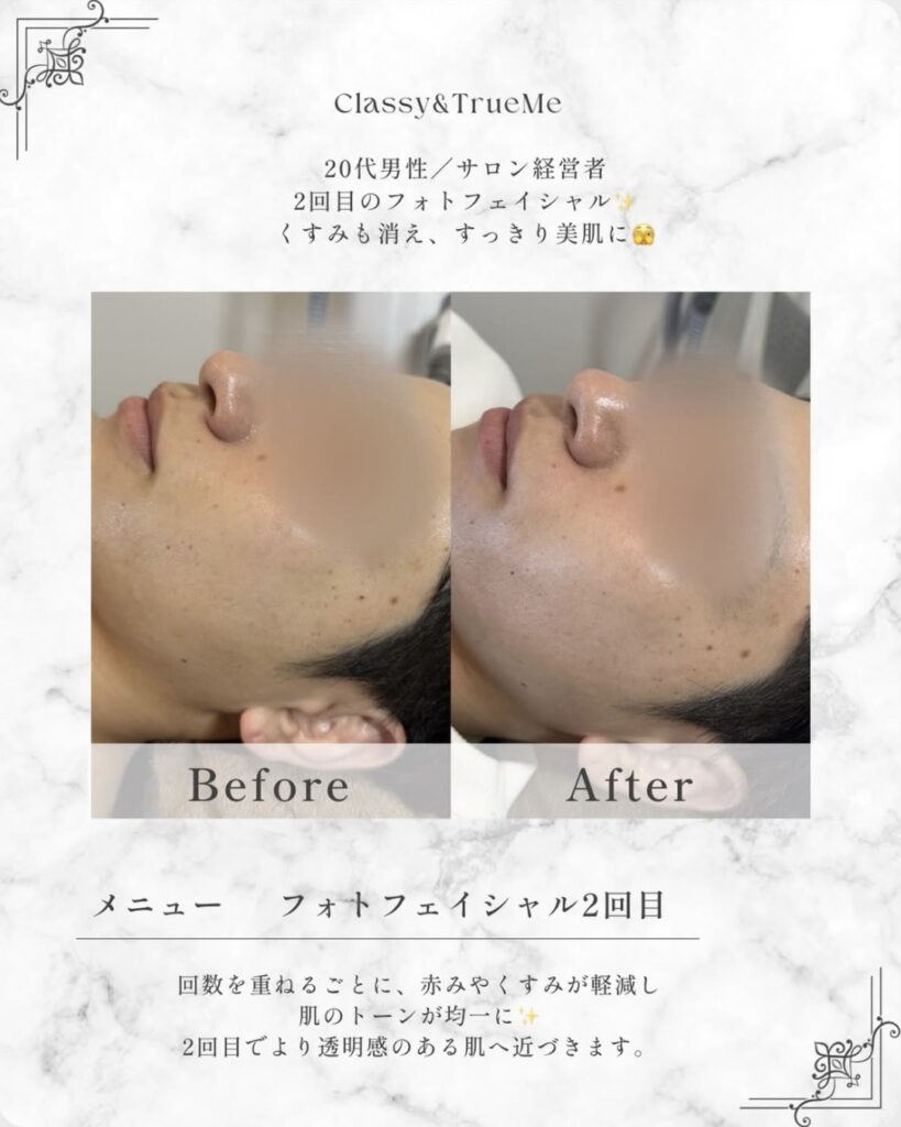 Classy&TrueMe印象管理専門店でメンズ脱毛をしました部位はヒゲ脱毛です。
脱毛できれいになった肌をトーンアップする為にフォトフェイシャルをしています。
くすみも消えて美肌になりました。