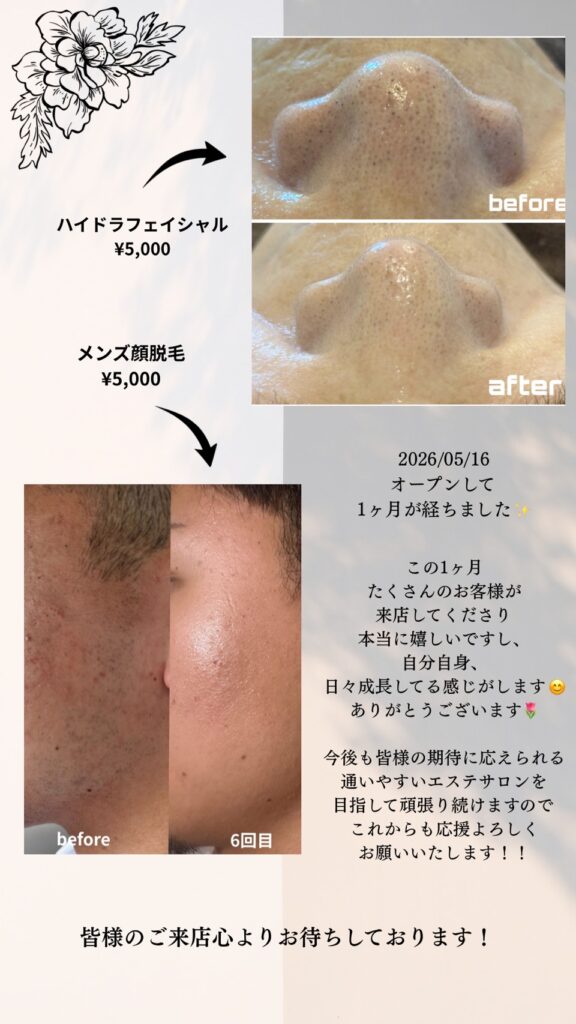 名護市のエステサロンClassy&TrueMeで行ったハイドラフェイシャルの小鼻の毛穴洗浄とメンズ顔脱毛6回目のビフォーアフター症例写真