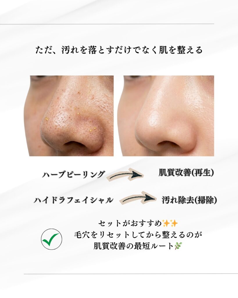 いちご鼻の黒ずみと角栓の劇的変化ハイのイメージ画像。ハイドラフェイシャルとハーブピーリングを組み合わせた肌質改善のおすすめ。