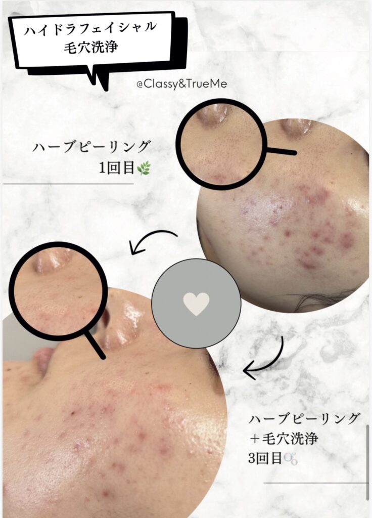 名護市印象管理専門店Classy＆TrueMeエステサロンで数回通われている女性の写真。繰り返すニキビと肌荒れが、３回の毛穴洗浄とハーブピーリングのセットで劇的に改善したビフォーアフター写真。※効果には個人差があります。