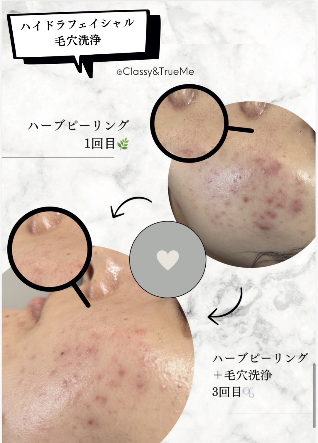名護市の毛穴洗浄サロンClassy＆TrueMeのハイドラフェイシャル・ビフォーアフター