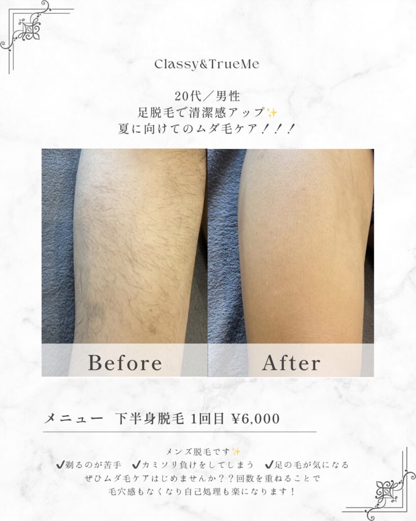 Classy＆TrueMeの20代男性向け下半身足脱毛1回目のビフォーアフター症例写真。すね毛のボリュームが減り清潔感がアップした足の様子