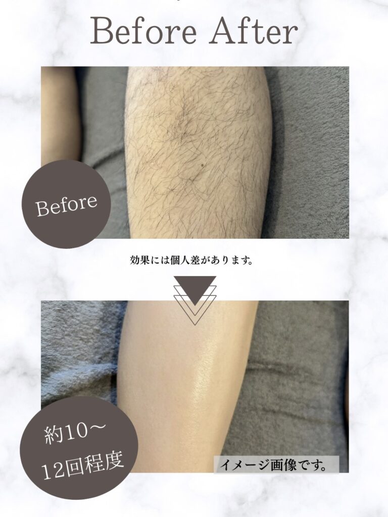Classy＆TrueMeで足脱毛を約10〜12回程度重ねた際の、毛穴が目立たなくなりツルツルで滑らかになった理想の素肌の仕上がりイメージ写真。