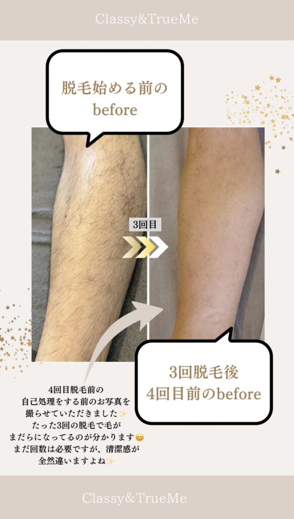 名護市の脱毛サロンClassy＆truMeによるすね毛脱毛画像
