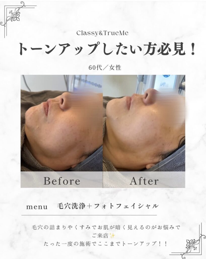 名護市Classy & True Meの毛穴洗浄とフォトフェイシャルによる60代女性のトーンアップビフォーアフター