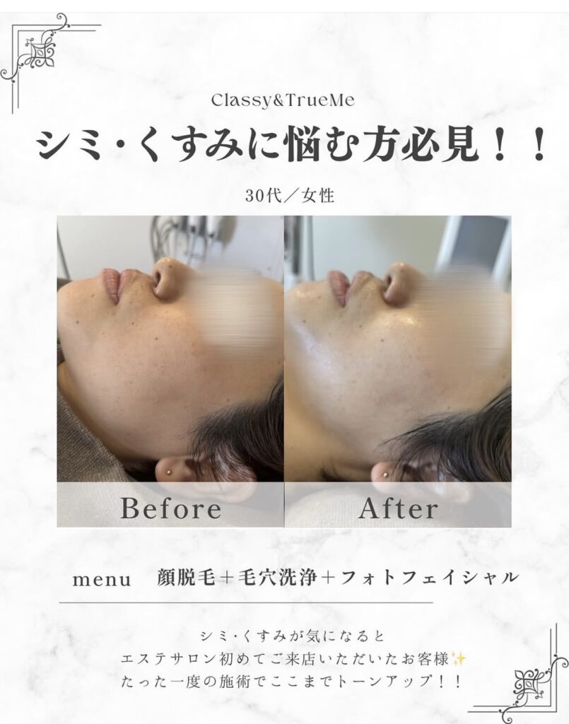 名護市のサロンClassy & True Meでの30代女性のシミ・くすみフォトフェイシャルビフォーアフター