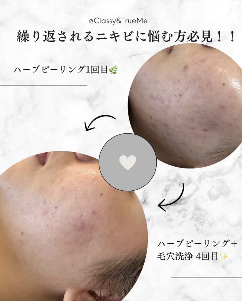 名護市Classy & True Meのハーブピーリングと毛穴洗浄によるニキビ肌ビフォーアフター