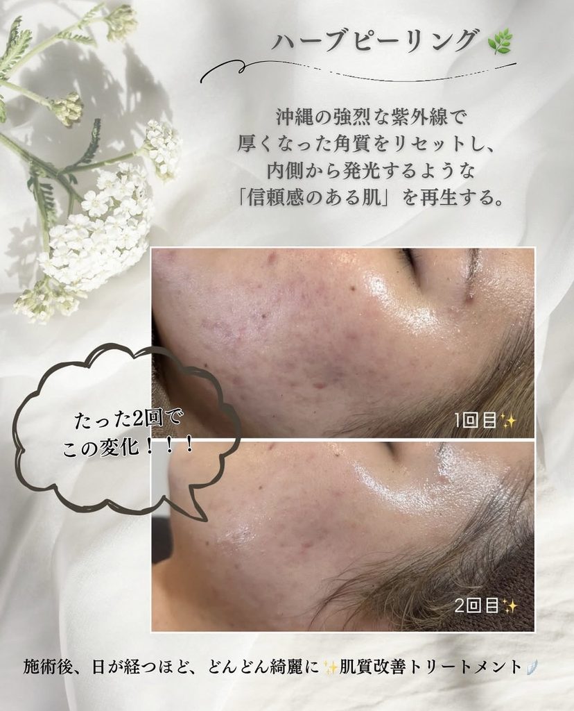名護市のエステサロンClassy＆TrueMeのハーブピーリング施術前後の肌状態比較